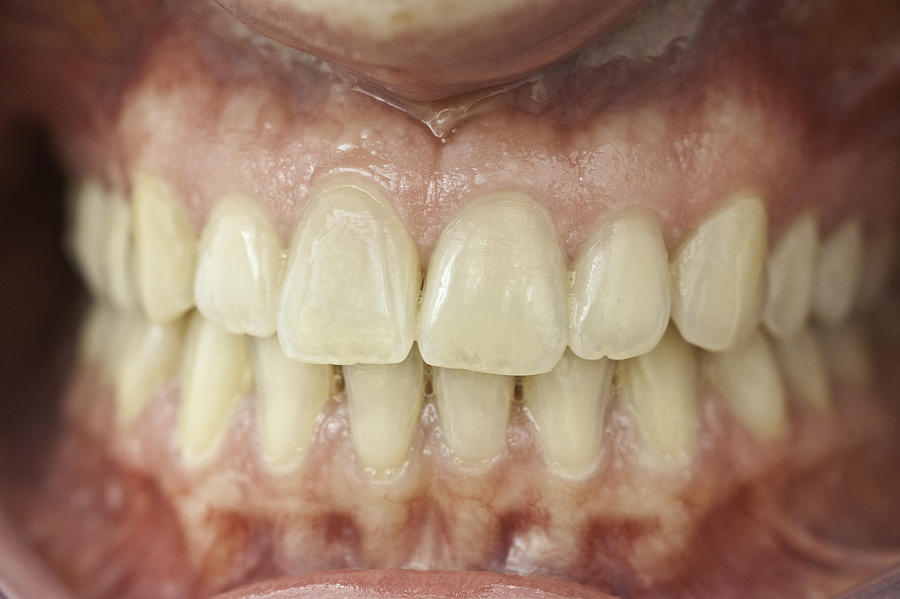 set of healthy human dentures - Zähne mit Zahnfleisch Photograph by Wakila