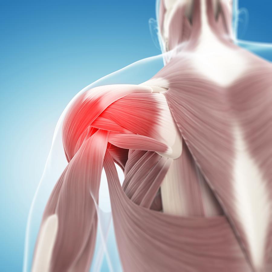 Shoulder pain, conceptual artwork Drawing by Science Photo Library - SCIEPRO