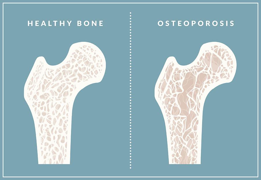 Simple illustration comparing healthy bone and osteoporosis Drawing by Wetcake