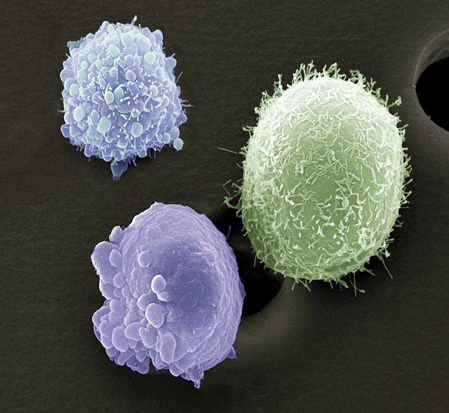 Skin cancer cells, scanning electron microscope (SEM) Photograph by Science Photo Library - STEVE GSCHMEISSNER.