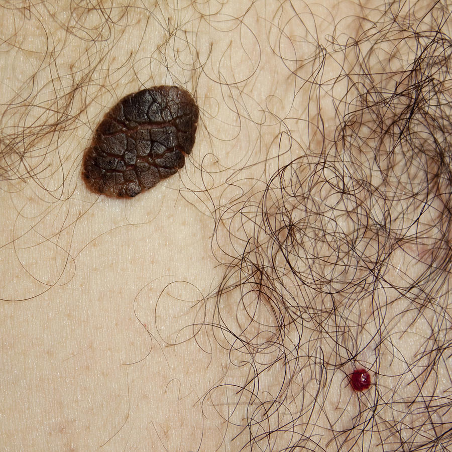 Skin problems - Seborrhoeic Keratosis and Cherry Angioma Photograph by Whitemay