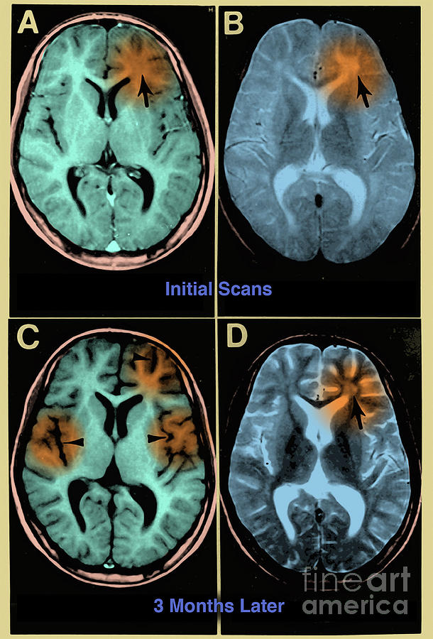 Subacute Sclerosing Panencephalitis Photograph by Science Source
