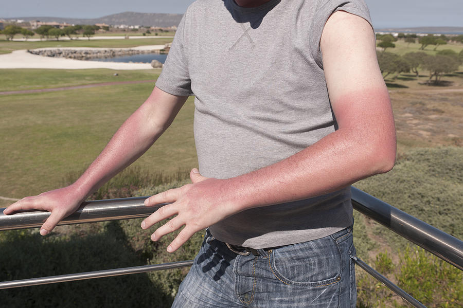 Sunburn Photograph by JohnnyGreig