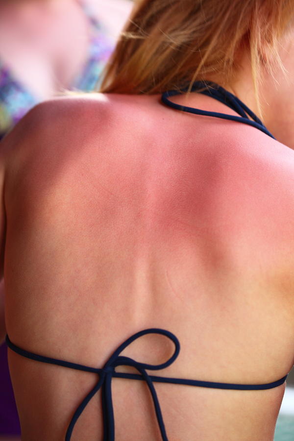 Sunburned Back and Shoulders girl Photograph by D. Sharon Pruitt Pink Sherbet Photography