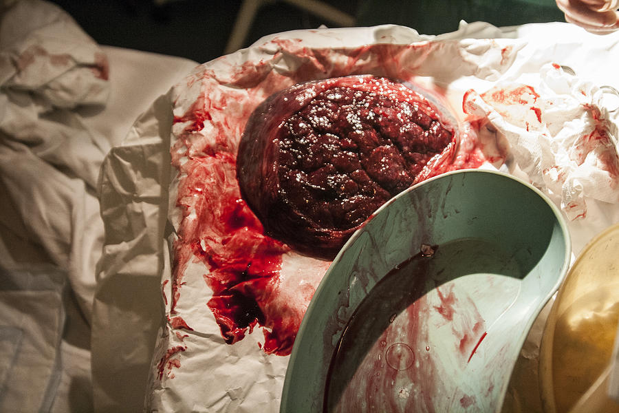 The Placenta from new born baby. Photograph by Roy JAMES Shakespeare
