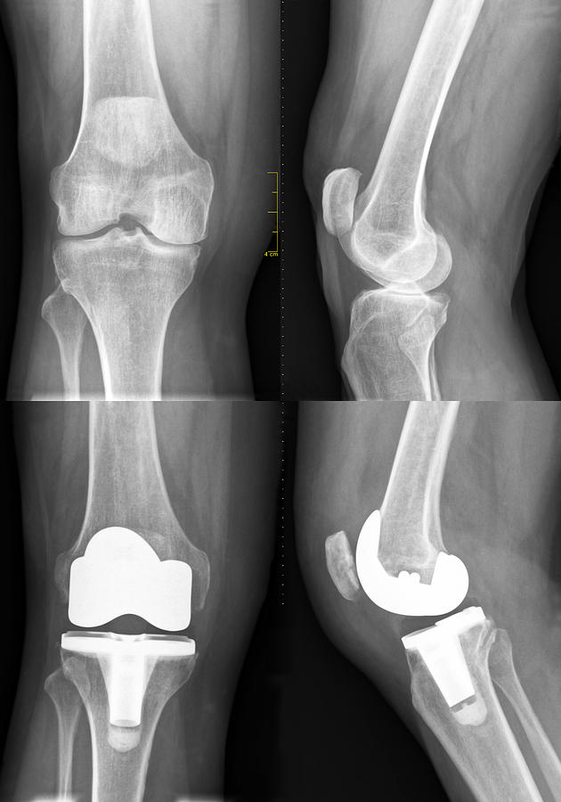 Total Knee Replacement, before and after Photograph by Manx_in_the_world