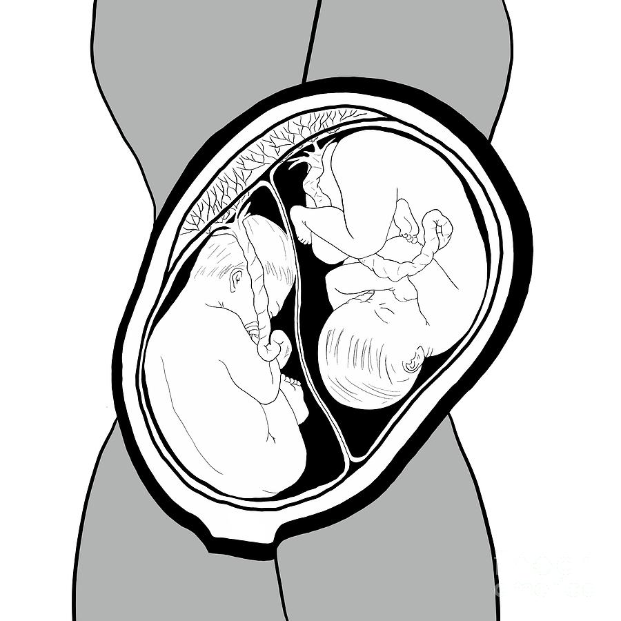 Twins In The Womb Digital Art By Krista Kitsz - Fine Art America