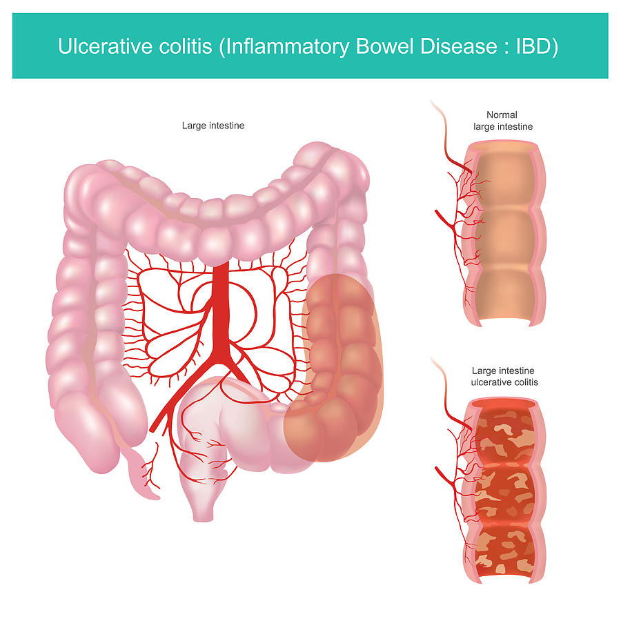 Ulcerative colitis Drawing by Graphic_BKK1979