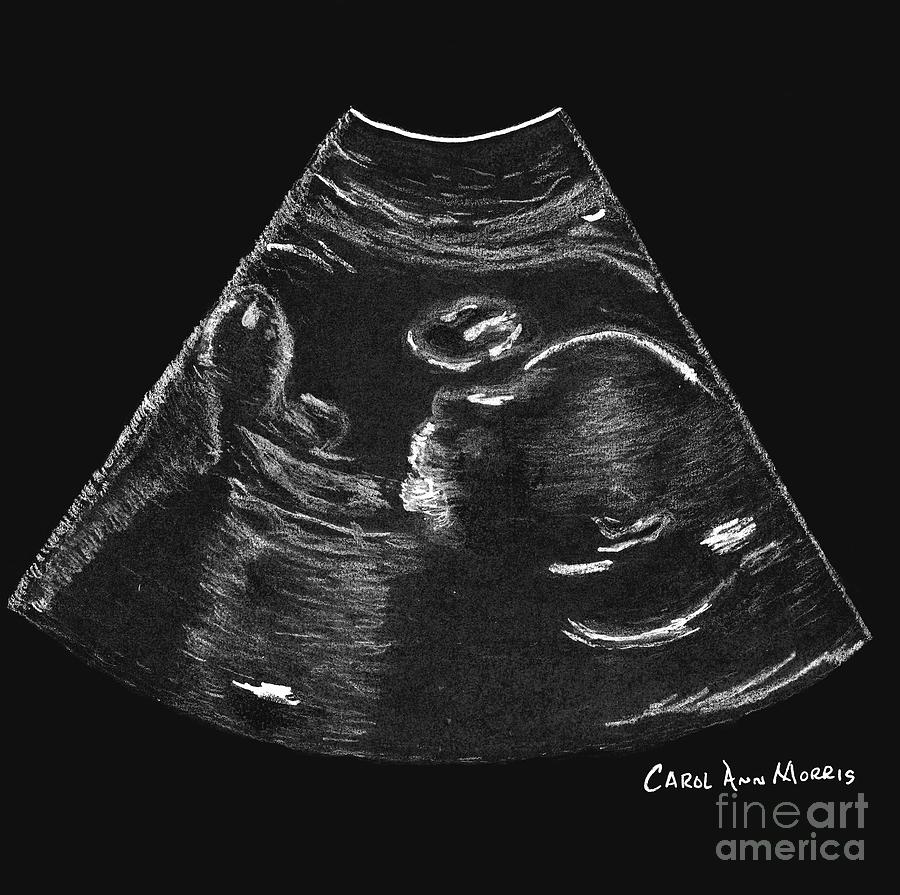 Ultrasound baby Drawing by Carol Morris