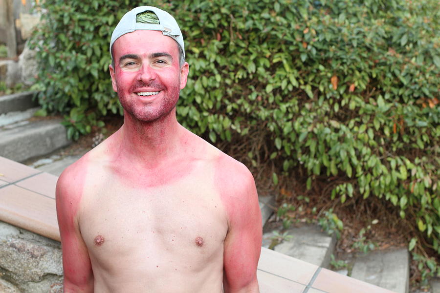 Unconscious sunburned man with horrible skin irritation Photograph by Ajr_images