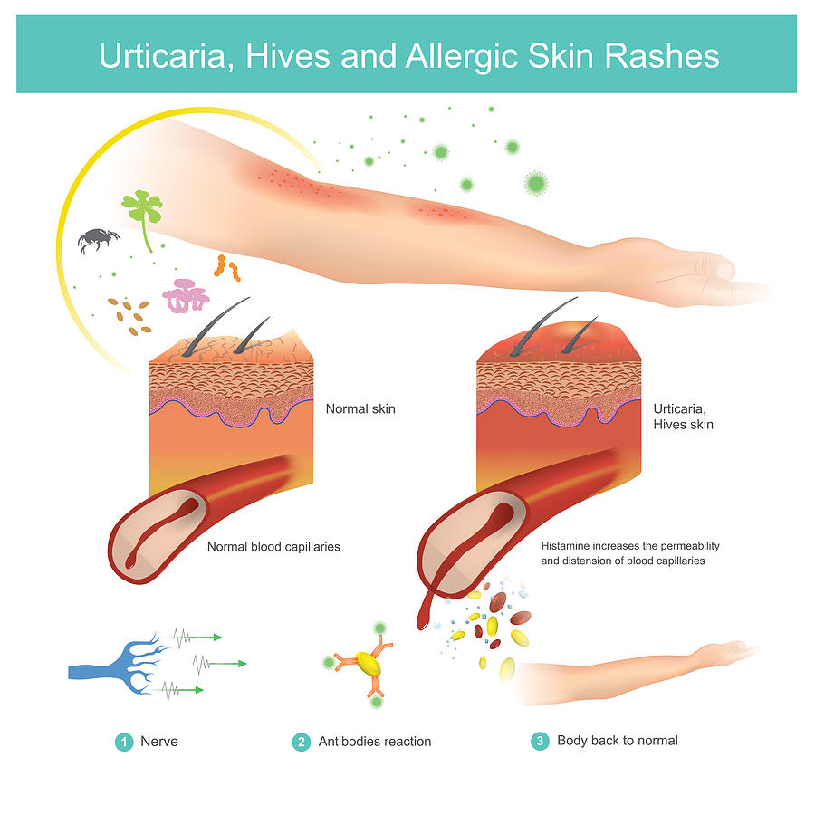 Urticaria, Hives and Allergic Skin Rashes. Illustration. Drawing by Graphic_BKK1979