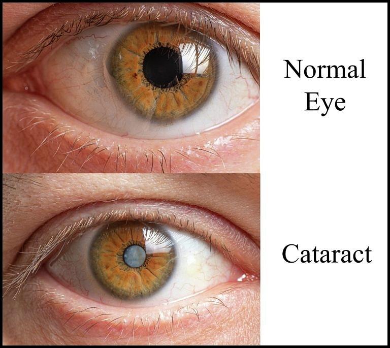 What is Cataract - Symptoms, Causes, and Treatment? Mixed Media by ...