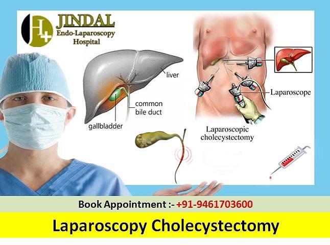 What is Cholecystectomy and How is Performed? - Jindal Laparoscopy ...