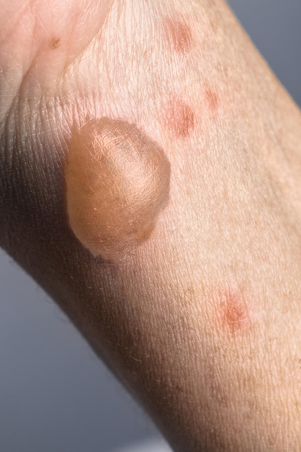 Woman arm with actual second degree burn Photograph by Apomares