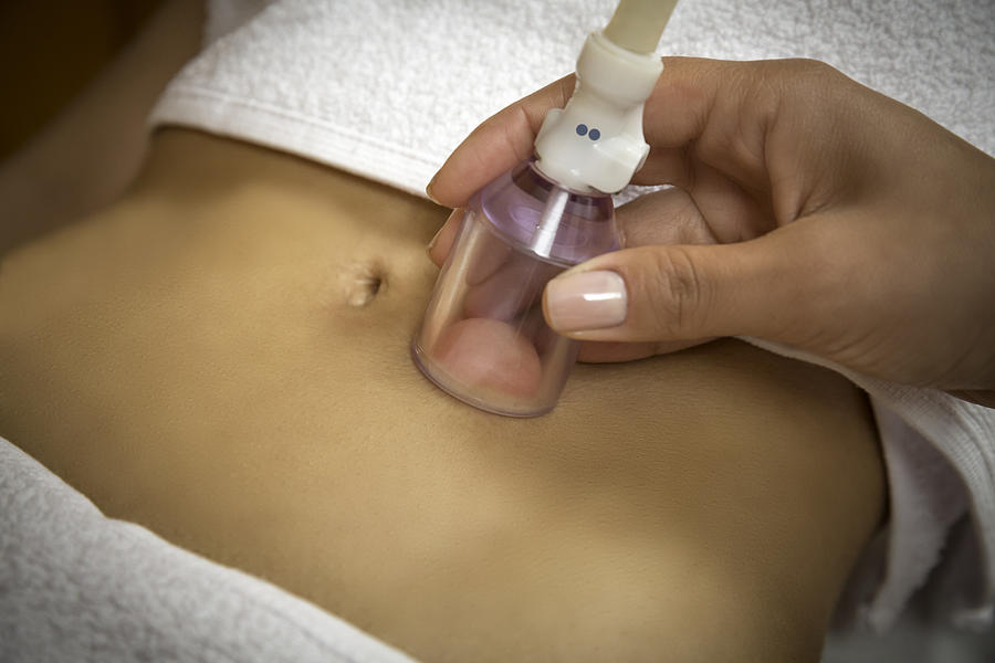 Woman getting cellulite vacuum therapy on abdomen Photograph by Apomares