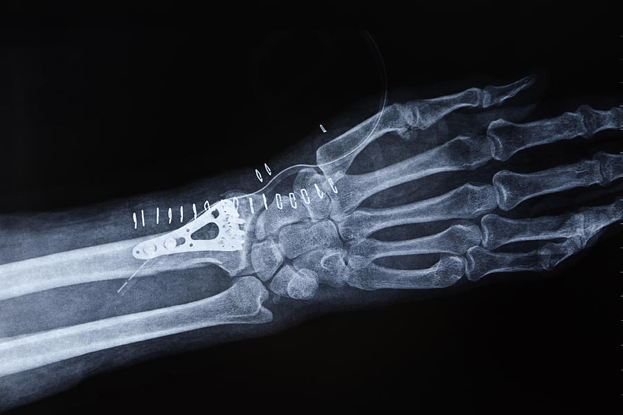 X-ray image hand fracture Photograph by Pedre