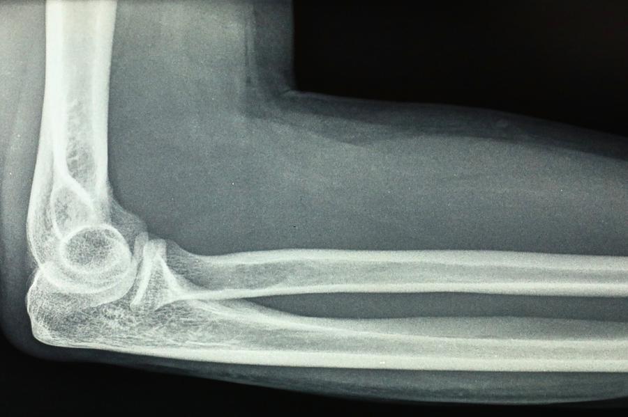 X-ray image of a human elbow and forearm Photograph by Douglas Sacha