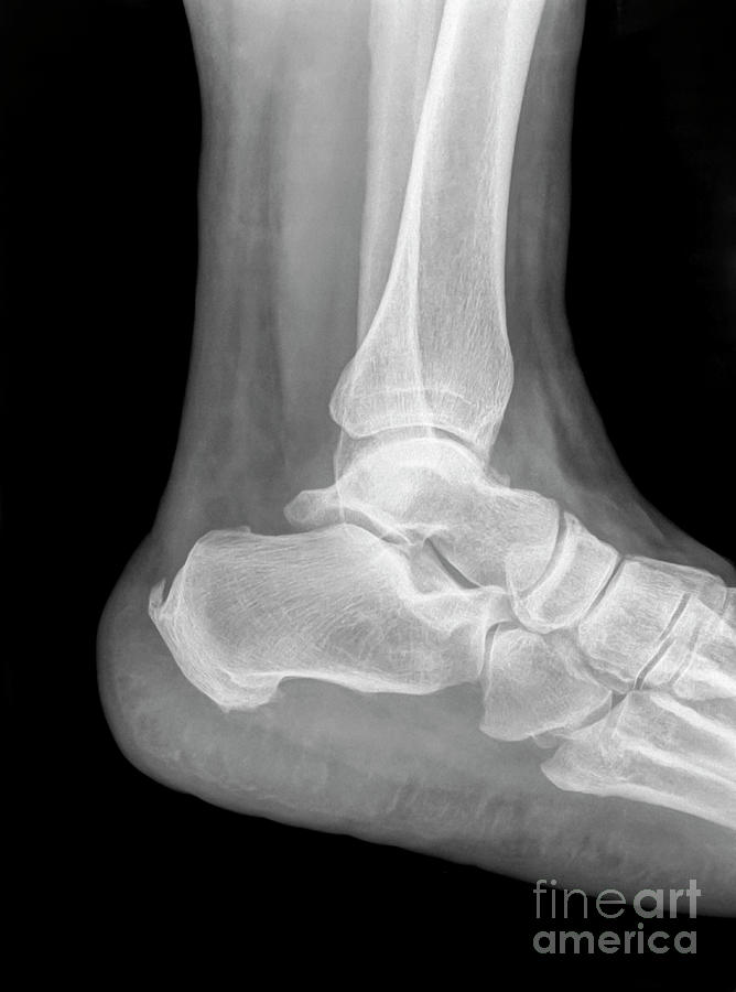 X-ray of an ankle n4 Photograph by Guy Viner