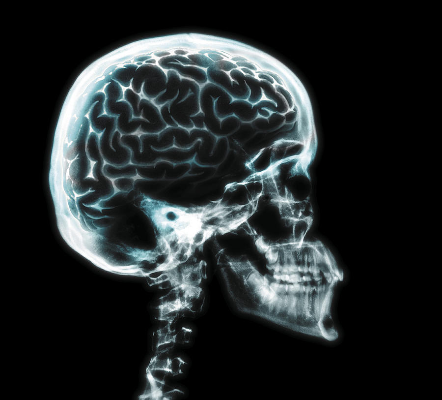 X-ray of brain in skull Photograph by Digital Vision.