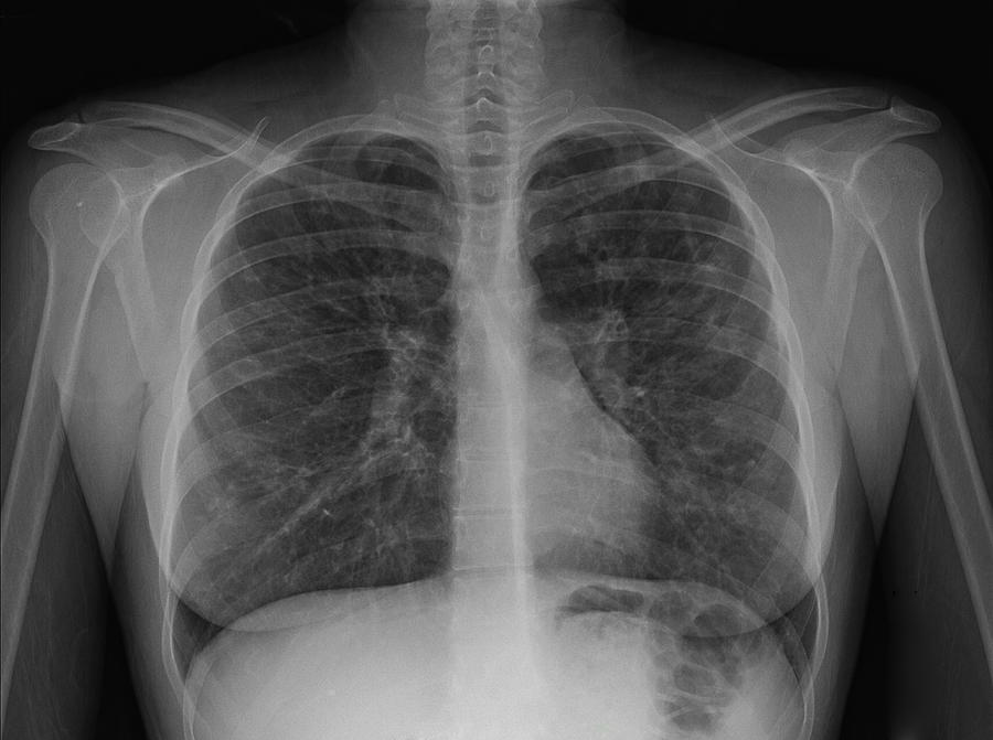 X-ray of chest showing cystic fibrosis Photograph by Callista Images
