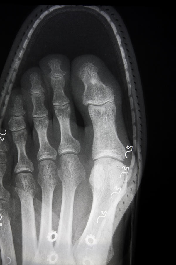 X-ray Of Foot In Shoe Photograph by Vandervelden