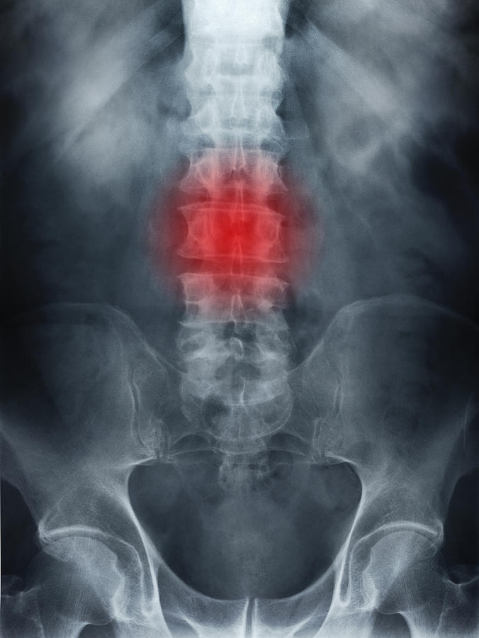 X-ray of spine showing back ache Photograph by Peter Dazeley