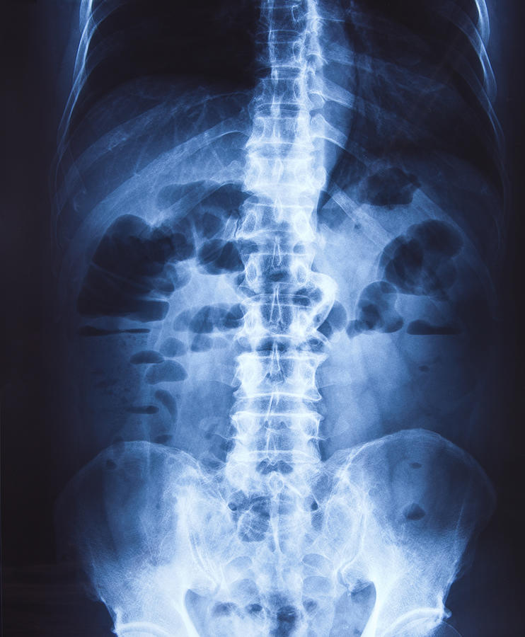 X-ray of the pelvis and spinal column Photograph by Suradin