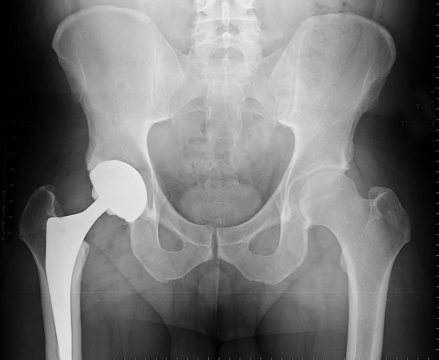 X-ray Of Total Hip Arthroplasty Photograph by 33karen33