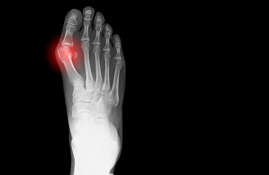 X-ray showing bunion on human foot Photograph by Peter Dazeley