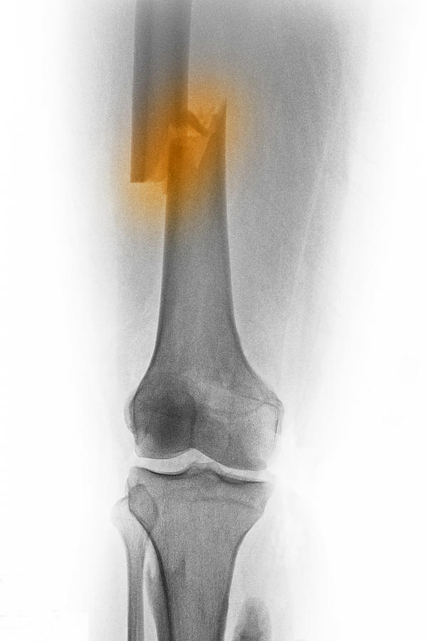 X-ray Showing Femur Fracture From Auto Accident Photograph by SMC Images