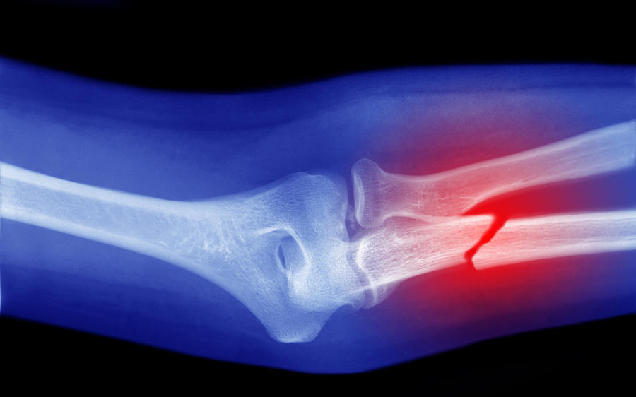 Xray Of Broken Arm Photograph by Peter Dazeley