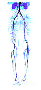 Atherosclerosis, Ct Angiogram #2 Photograph by Living Art Enterprises