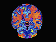 Coronal View Mri Of Normal Brain Photograph by Medical Body Scans Coronal View Mri Of Normal Brain Photograph by Medical Body Scans
