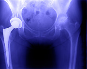 Hip Replacement Photograph by Ted Kinsman Hip Replacement Photograph by Ted Kinsman
