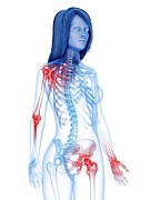 Painful Joints #1 Photograph by Science Photo Library