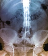 Spine In Ankylosing Spondylitis #6 Photograph by Science Photo Library