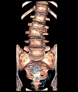 Arthritic Spine Photograph by Science Photo Library