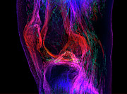 Knee Joint Photograph by Science Photo Library