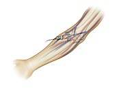 Long Line Insertion Photograph by Science Photo Library
