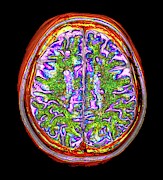 Multiple Sclerosis Photograph by Science Photo Library