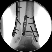 Pinned Fractured Ankle Bones Photograph by Science Photo Library