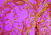 Placental Villi With Syphillis Photograph by 