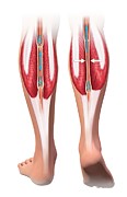 Skeletal-muscle Pump For Leg Veins Photograph by Science Photo Library