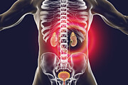 Chronic kidney disease, illustration #7 Drawing by Kateryna Kon/science Photo Library