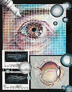 Macular Hole Repair Painting by Merana Cadorette