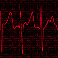 Atrial Fibrillation #3 Photograph by Science Source