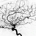 Dural Arterial Venous Fistula, Angiogram Photograph by Living Art Enterprises Dural Arterial Venous Fistula, Angiogram Photograph by Living Art Enterprises