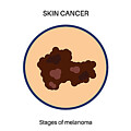 Melanoma Stages #3 Photograph by Pikovit / Science Photo Library
