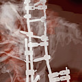 Spinal Prosthesis, Study 7 Digital Art by Veronica Huacuja Spinal Prosthesis, Study 7 Digital Art by Veronica Huacuja